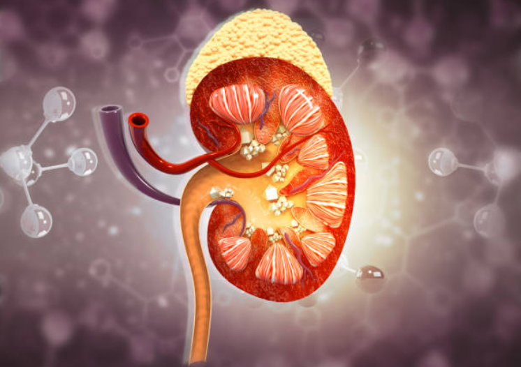 Kidney stone surgery
